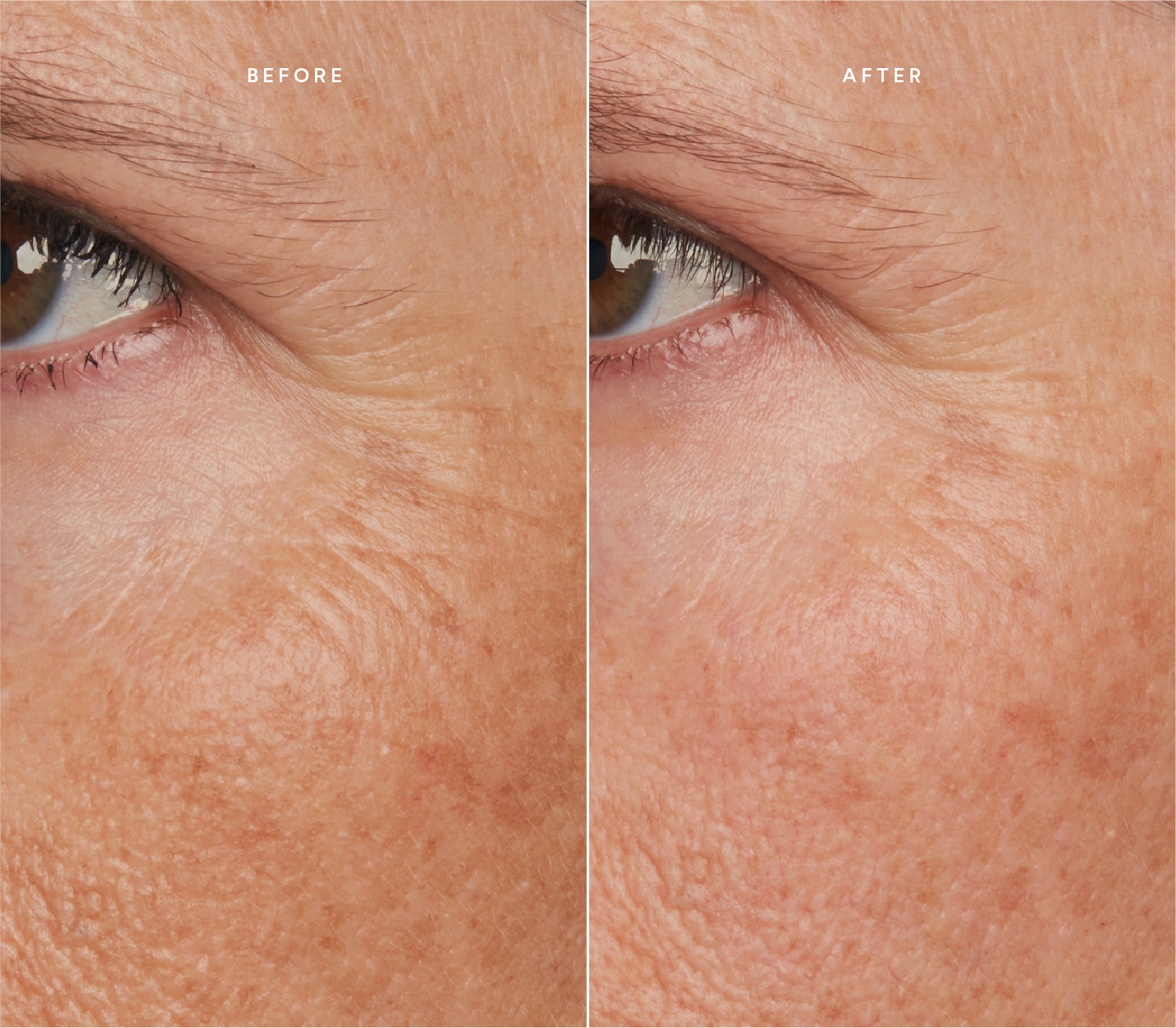 Before and after comparison showing smoother skin texture and reduced fine lines around the eye area.