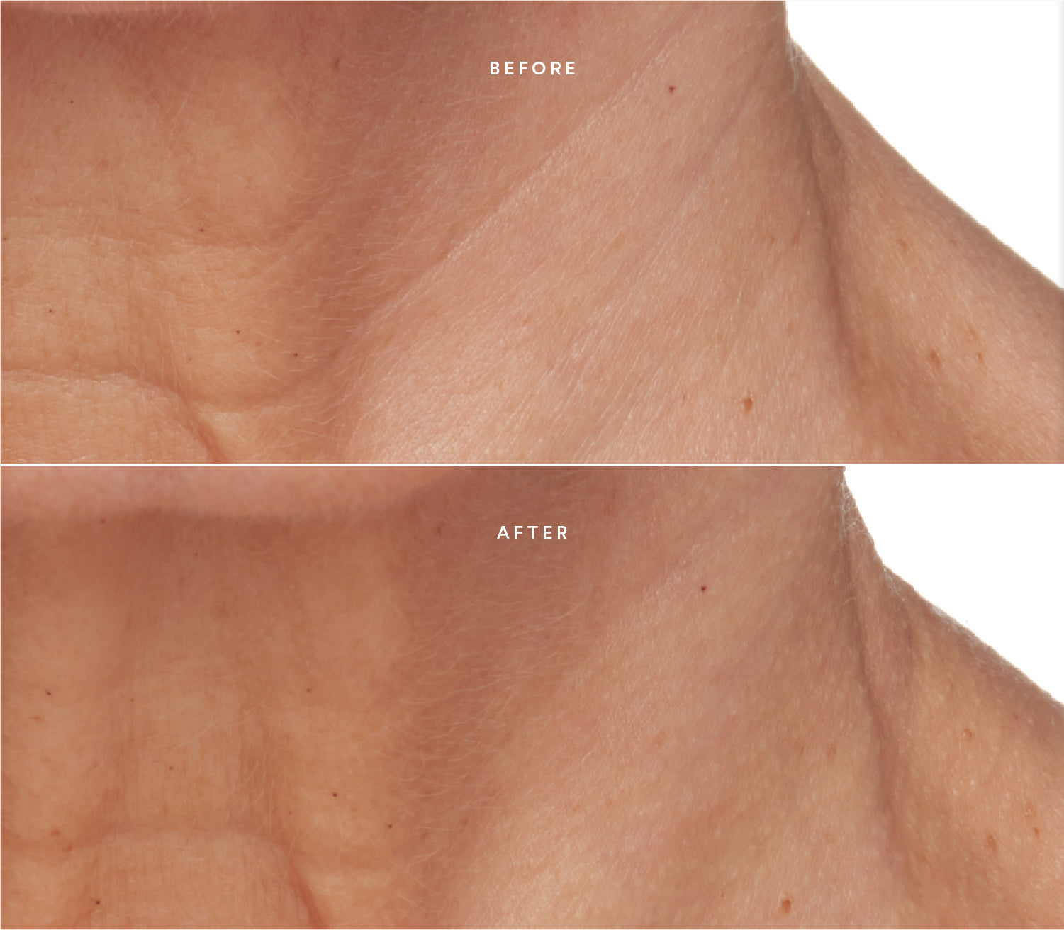 Before and after comparison showing smoother skin texture and reduced fine lines around the neck area.