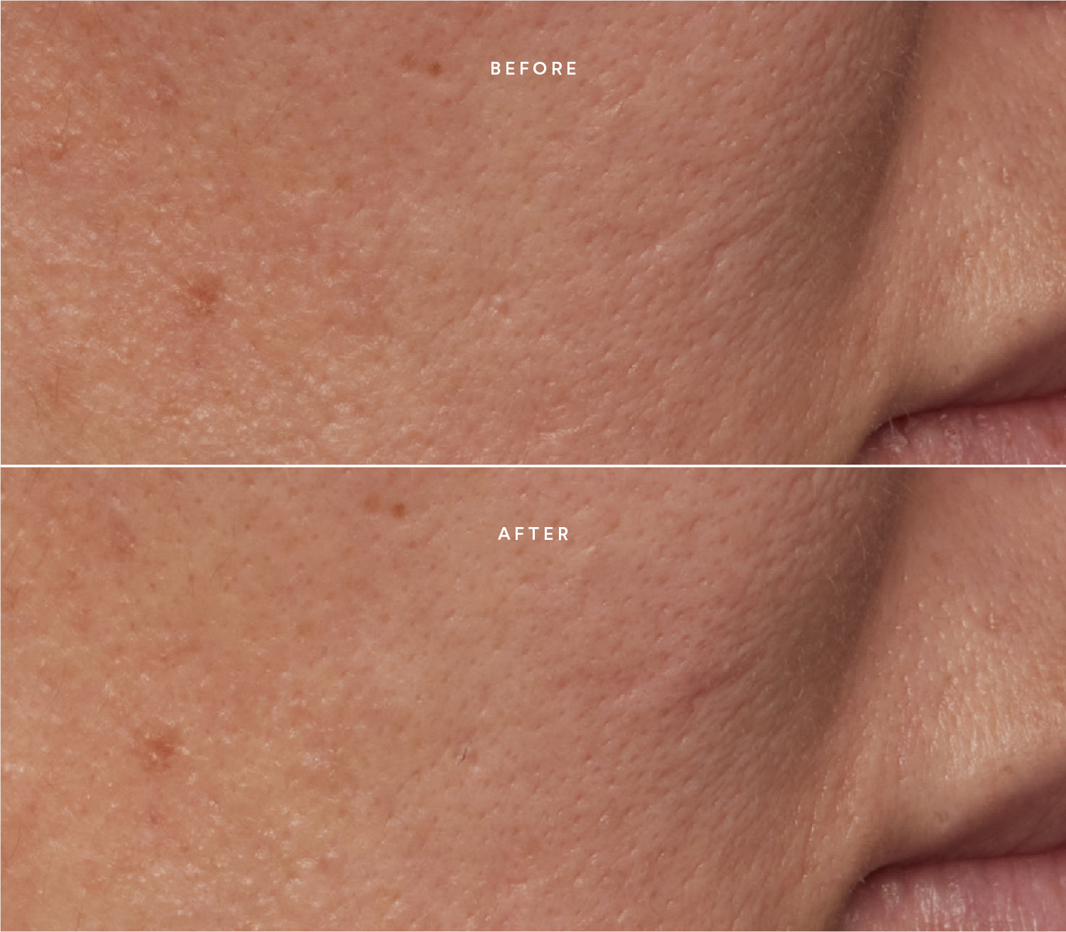 Before and after comparison showing improved skin texture and reduced blemishes.