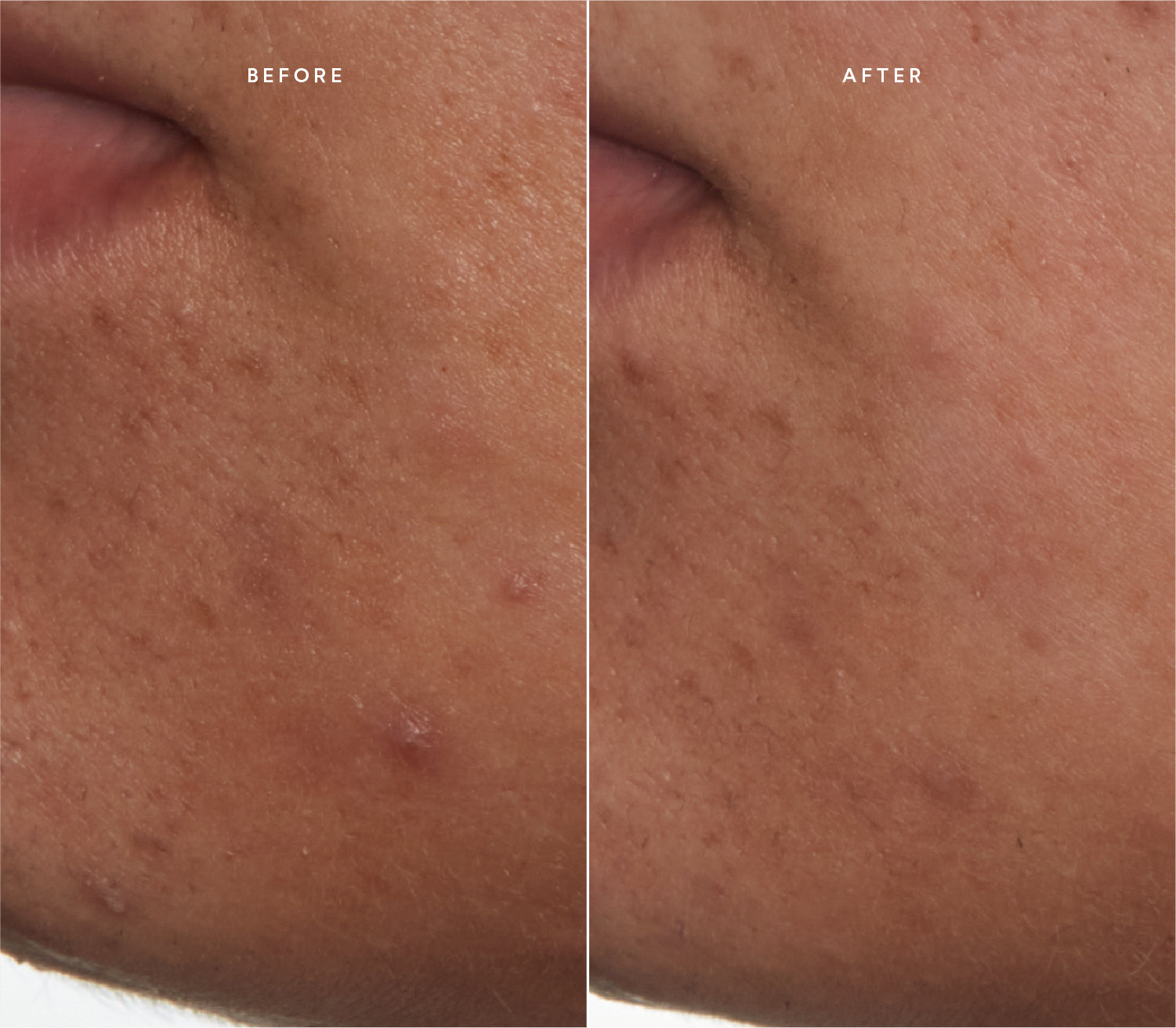 Before and after comparison showing improved skin texture and reduced blemishes.