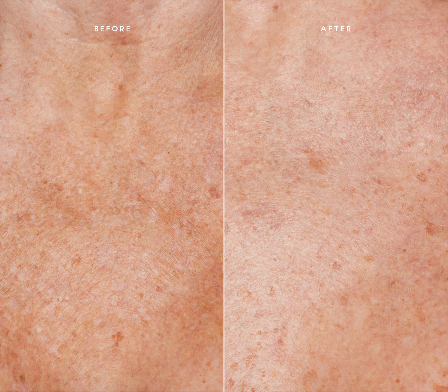 Before and after comparison showing improved skin texture and reduced blemishes.