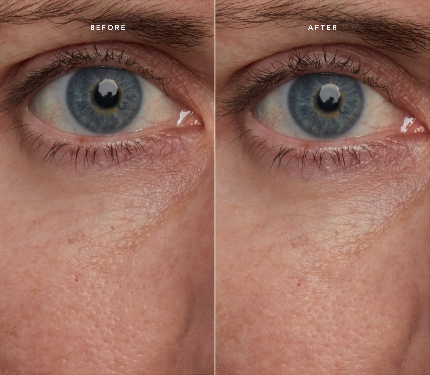 Before and after comparison showing smoother skin texture and reduced fine lines around the eye area.