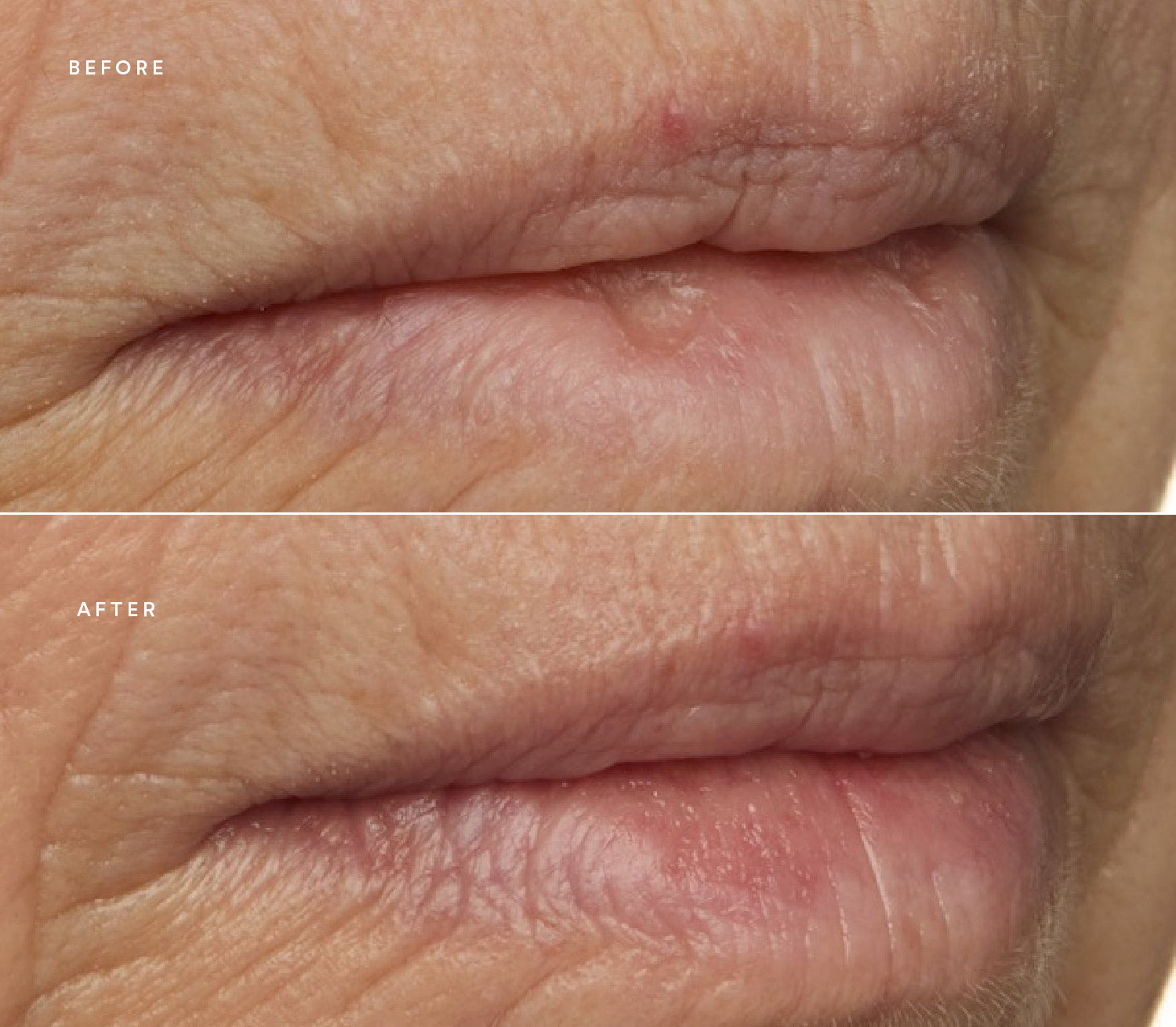 Before and after of lip images.