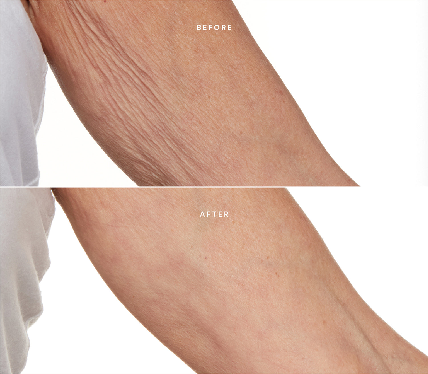 Before and after comparison showing improved skin texture and reduced sagginess on the arms.